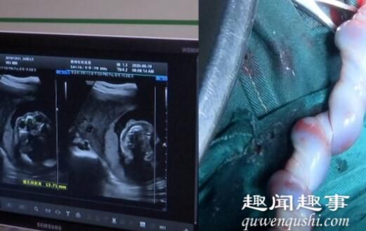女子怀孕8个月腹中突然没动静 医生剖腹手术后看到可怕一幕实在是太吓人了