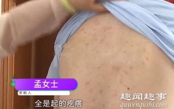 男子睡新床垫背部密密麻麻长痘 拆开一看瞬间傻眼