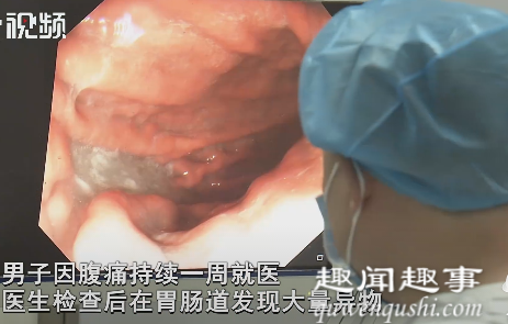 近日,湖南长沙,一男子腹痛拍片时发现大量异物,一看胃镜结果冷汗直流。