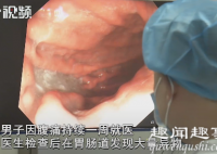 近日,湖南长沙,一男子腹痛拍片时发现大量异物,一看胃镜结果冷汗直流。