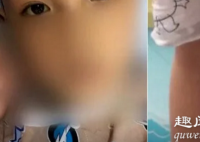 暑假过后,浙江杭州一名8岁男孩突然变成“小黄人”被送往医院,医生做各种检查都查不出病因