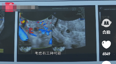 贵州贵阳董先生的妻子怀孕没多久,就出现流血问题,由于妻子曾有过宫外孕经历