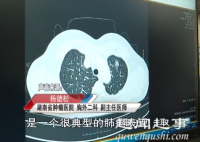 10月12日,湖南5旬大妈不抽烟不喝酒却查出肺癌,医生道破原因。