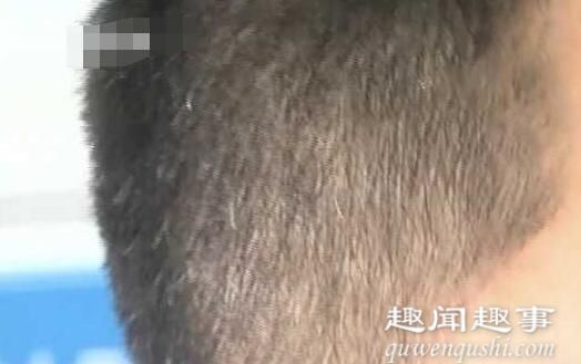 日前,广东一位90后小伙为治白发狂吃何首乌,不料20天后身体出现惊人变化。