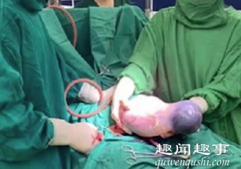 孕妇剖腹产生下双胞胎 医生抱出第二个孩子时惊呆了原因令人始料未及