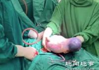 孕妇剖腹产生下双胞胎 医生抱出第二个孩子时惊呆了原因令人始料未及