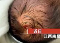 出生仅4天婴儿被蜱虫咬伤 内幕曝光简直太恐怖了