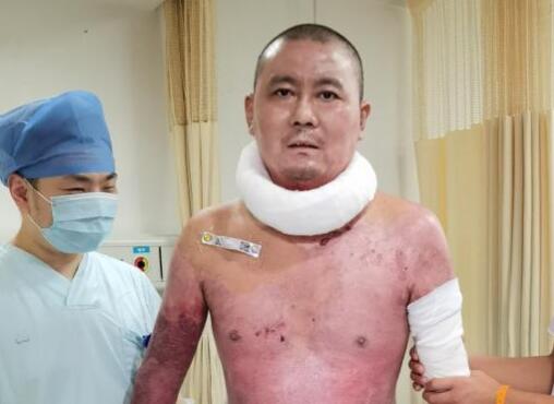 杭州电动车爆燃受伤父亲出院 到底是什么样了？