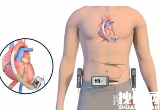 植入人工心脏后他成中国科技迷弟 究竟是怎么回事？